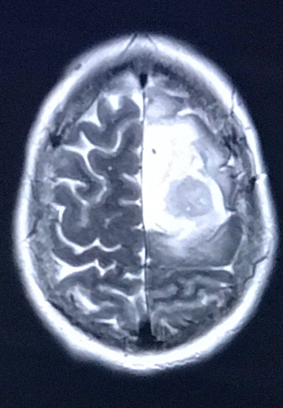 Glioblastoma Tumor MRI scan