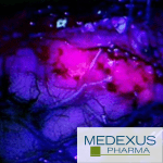 Innovative 5-ala imaging technique for GBM resection through Medexus Pharma