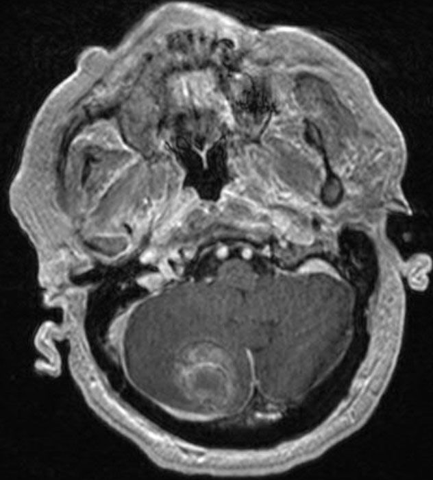 Minimally invasive tumor resection: Preoperative MRI shows a large cerebellar metastatic tumor.