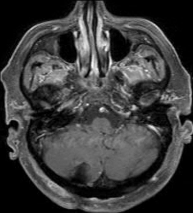 Postoperative imaging: Postoperative MRI shows complete resection of the large tumor. The patient went home on the day following the procedure.