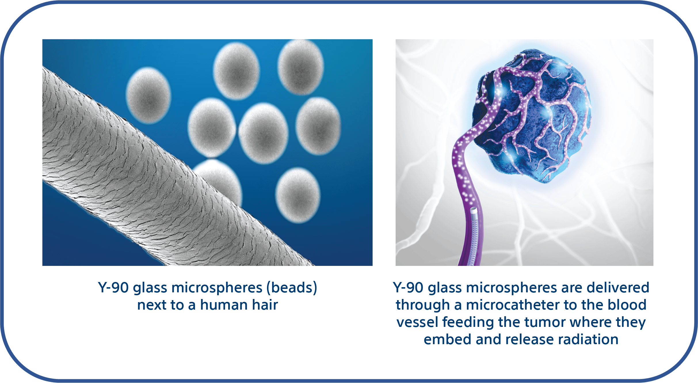 Image 1: Y-90 glass microspheres (beads) next to human hair. 
Image 2: Y-90 glass microspheres are delivered through a microcatheter to the vessel feeding the tumor where they embed and release radiation