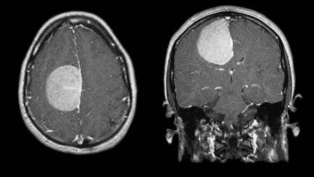 MRI of a meningioma